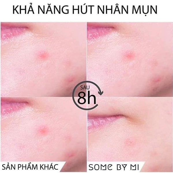 miếng dán mụn some by mi